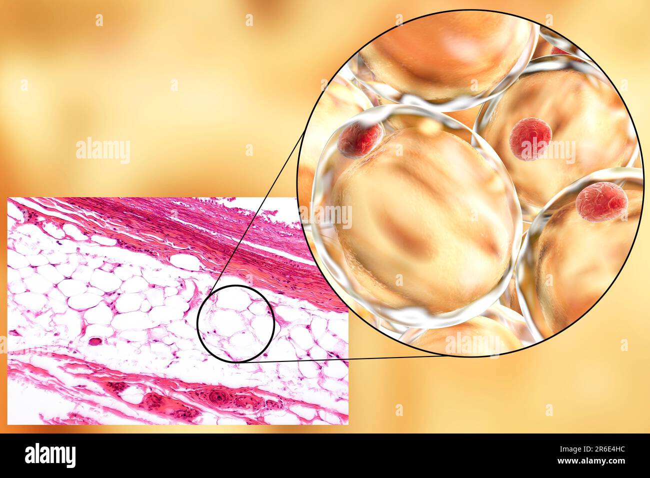Células de grasa, micrografía de luz e ilustración de computadora. Tejido adiposo blanco compuesto de adipocitos (células grasas). Los adipocitos forman tejido adiposo, que Foto de stock