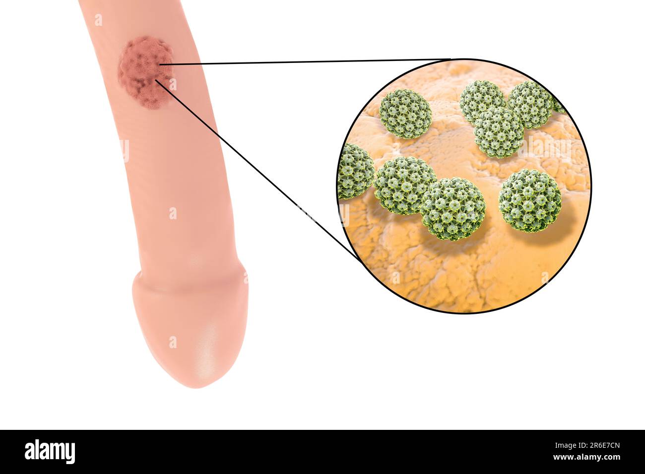 Verrugas Del Pene Genitales Y Vista De Cerca Del Virus Del Papiloma Humano Ilustración Por 9752