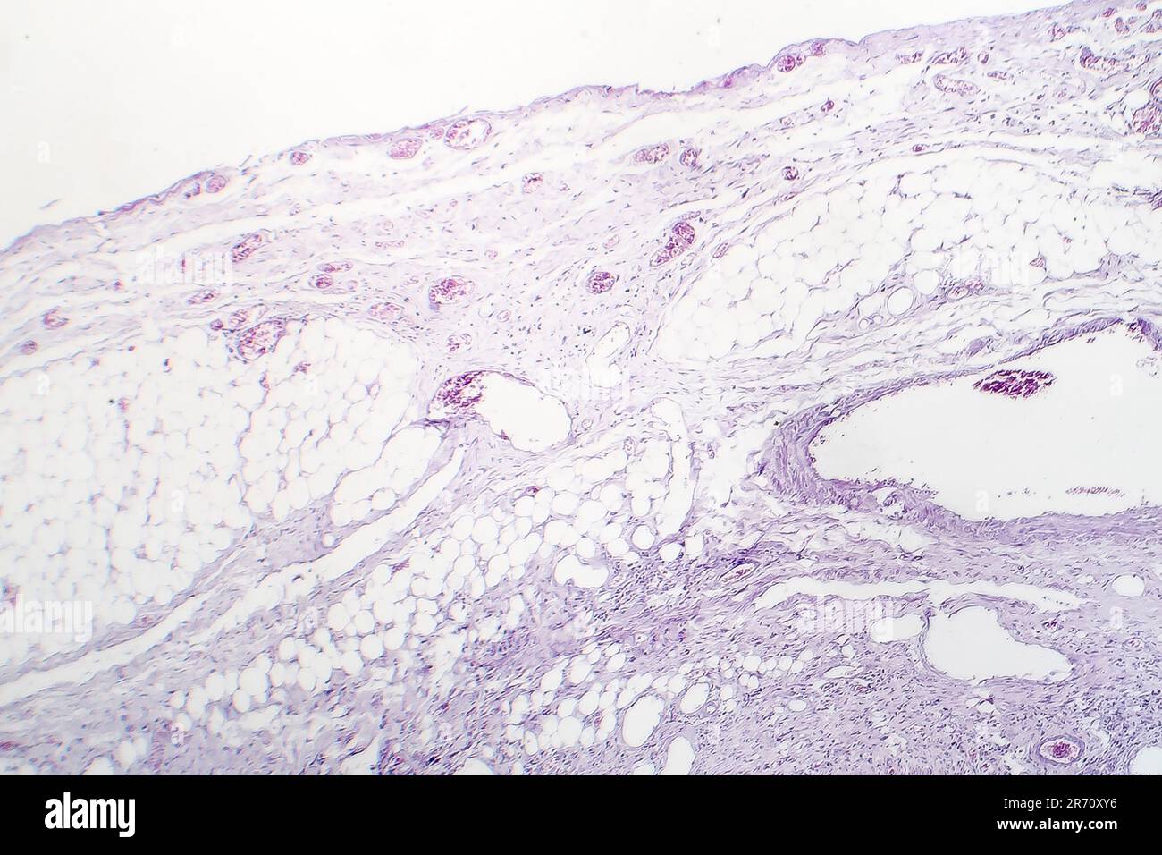 Inflamación granulomatosa, micrografía de luz, foto bajo microscopio Foto de stock