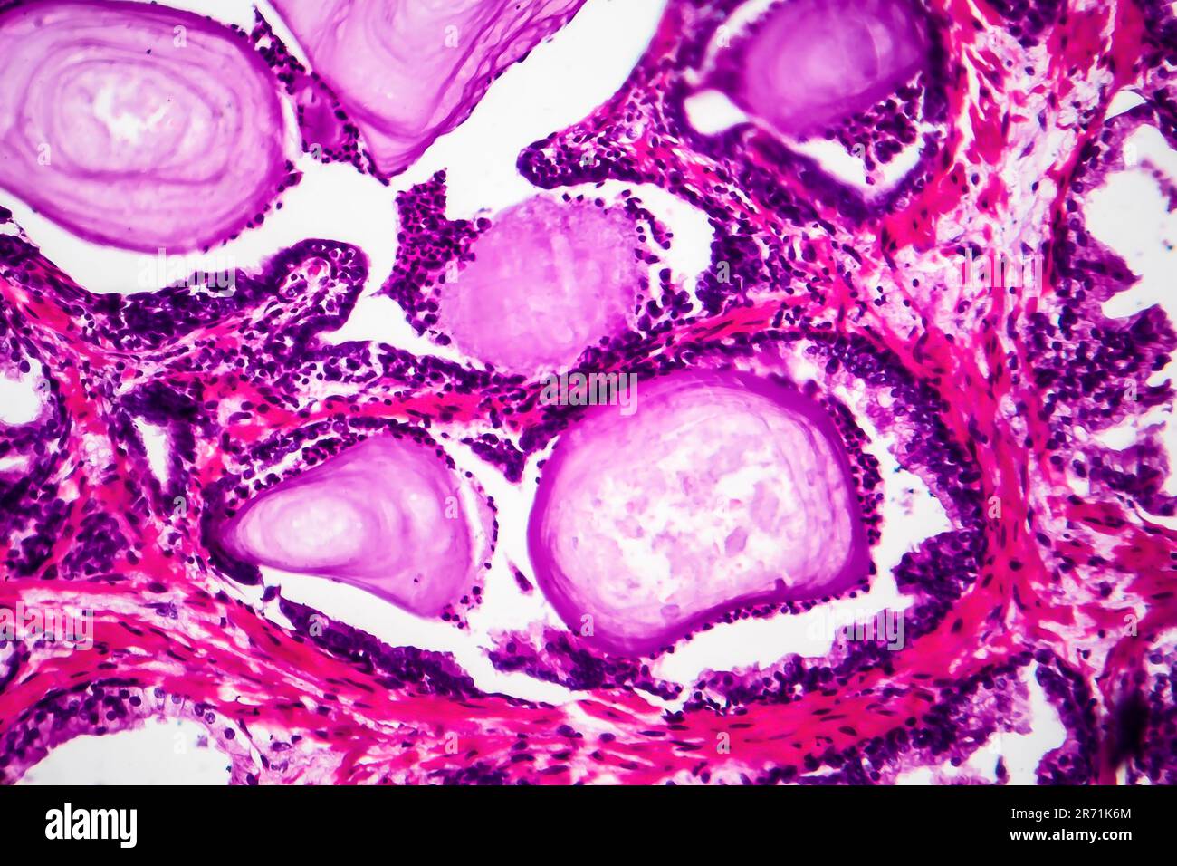 Hiperplasia prostática benigna, micrografía de luz, foto al microscopio que muestra glándulas dilatadas, acumulación de material secretorio Foto de stock