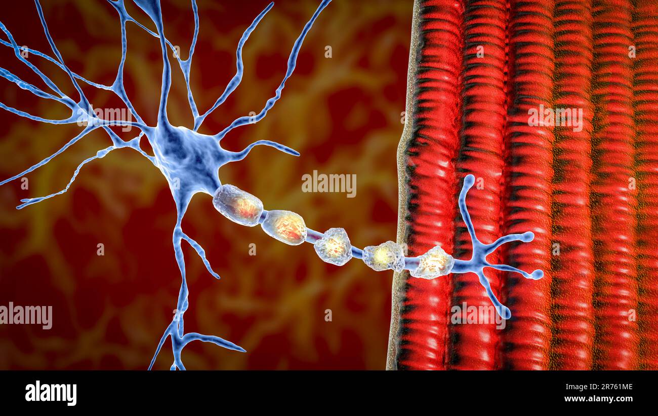 Desmielinización de la neurona, el daño de la vaina de mielina de la neurona que se observa en enfermedades desmielinizantes, como la esclerosis múltiple y otros mielinizadores Foto de stock