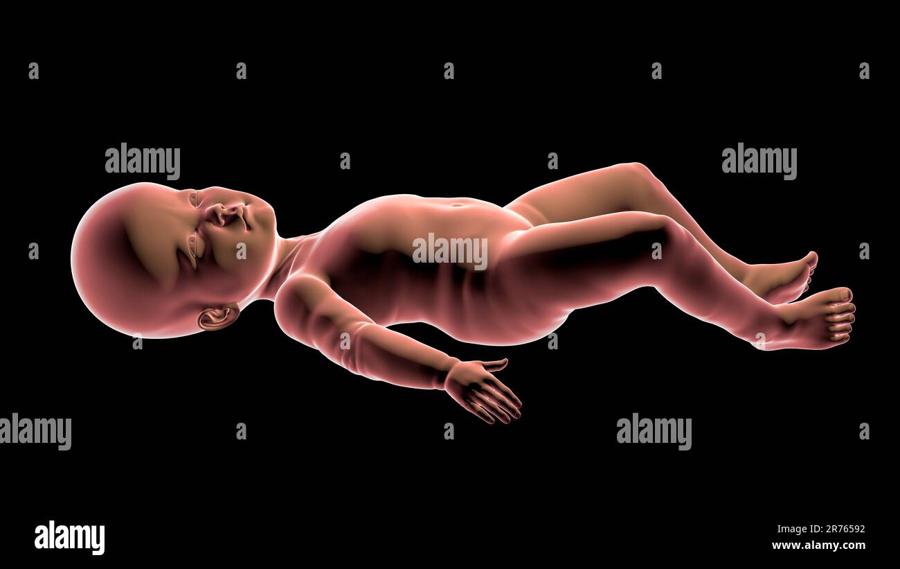 Un niño con macrocefalia, agrandamiento del cerebro, hipotonía, retraso mental y motor debido a trastorno genético, ilustración por computadora. Foto de stock