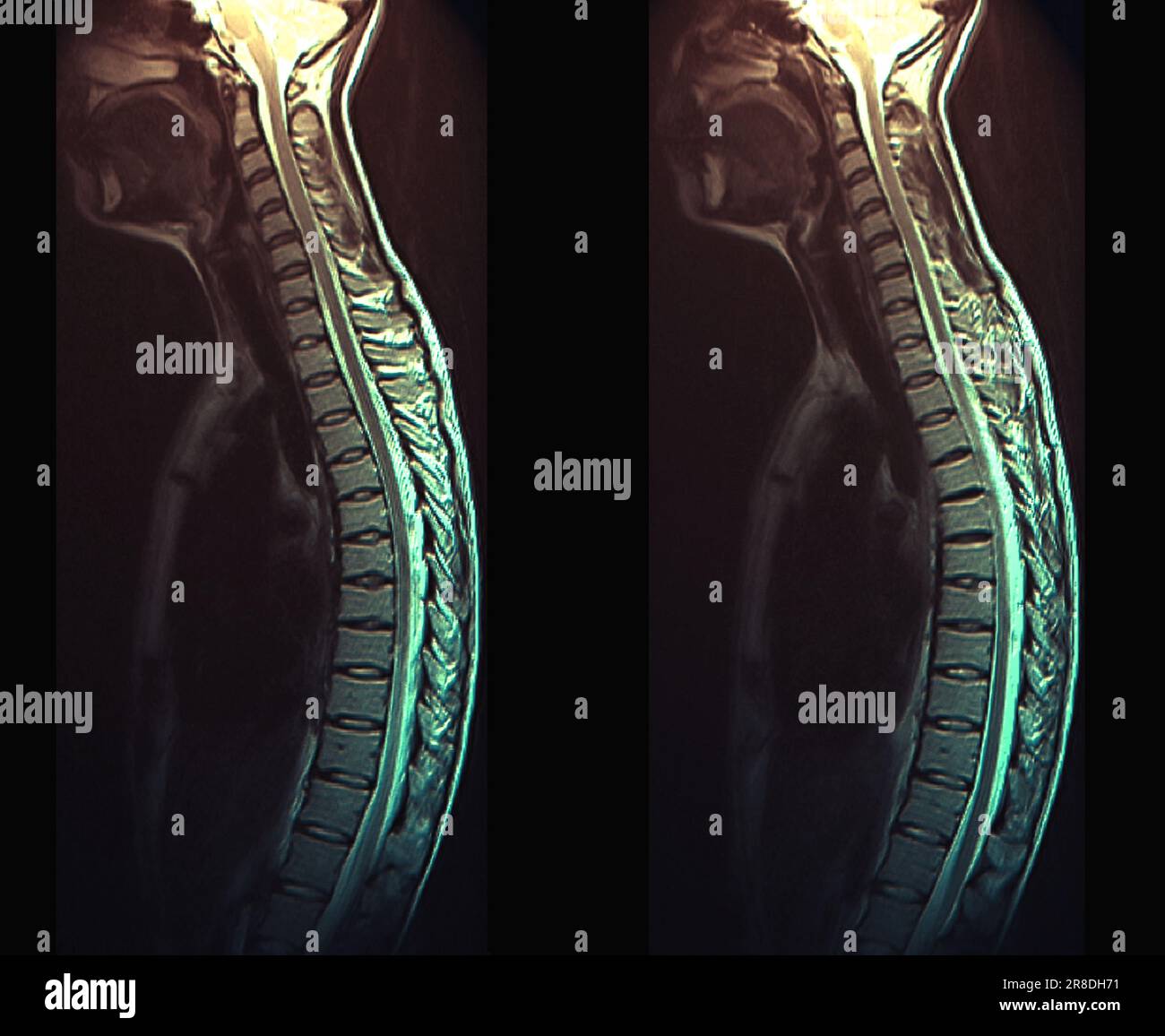 Im Genes Radiol Gicas A Rmn De Columna Cervical Preoperatoria B Hot Sex Picture