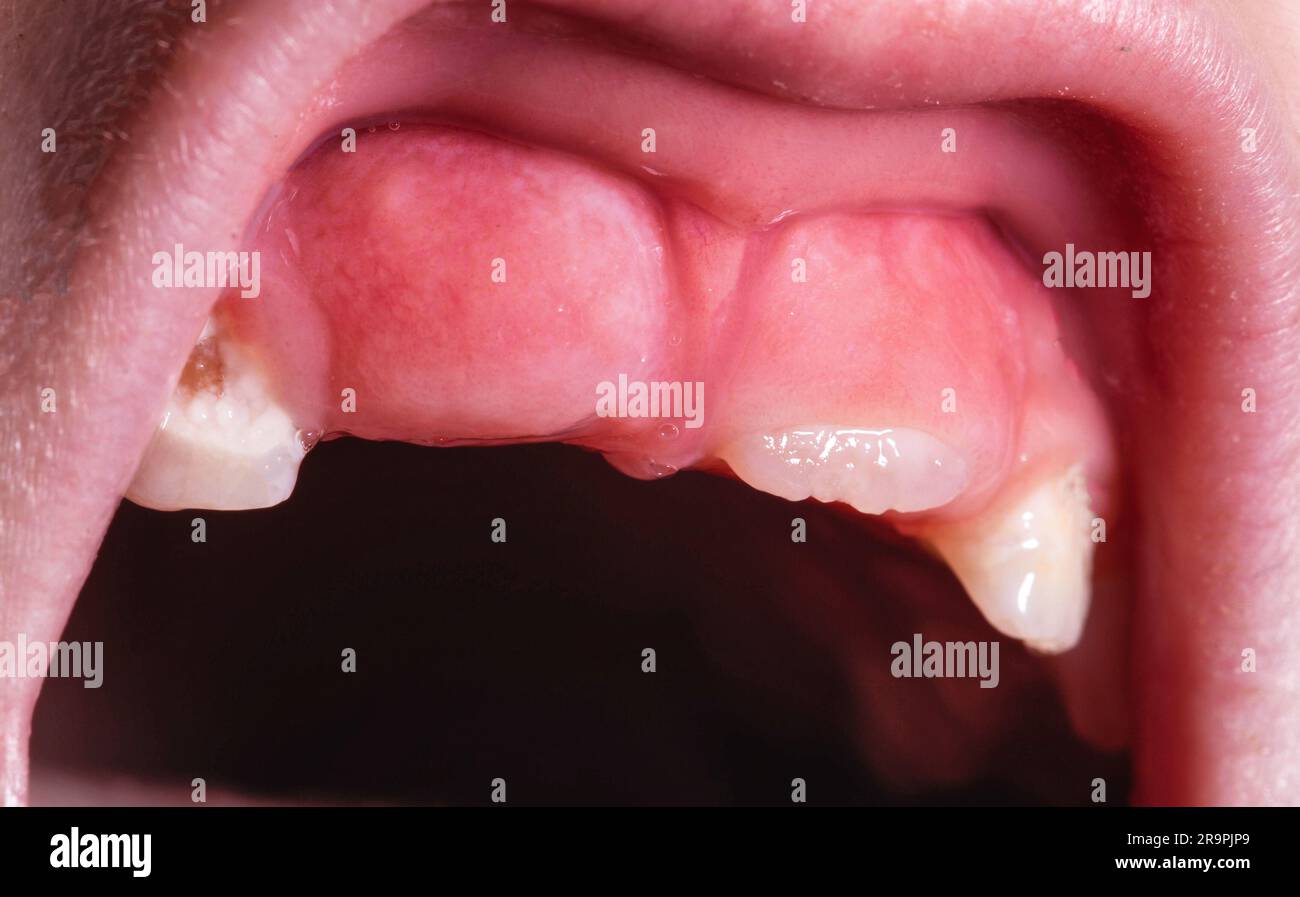 Un niño, de 6 años, tiene una caja para dientes de leche. Cambio de BANNER  de dientes, FORMATO LARGO Fotografía de stock - Alamy