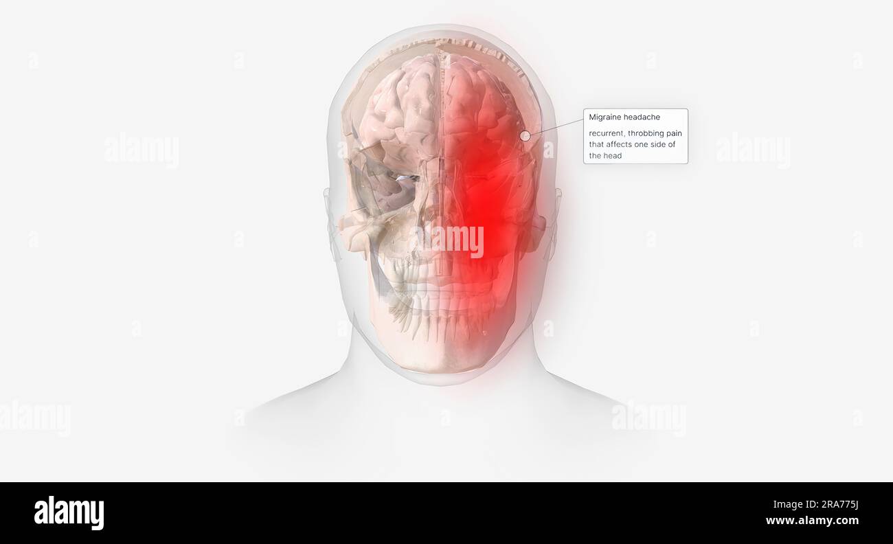 Los dolores de cabeza por migraña se caracterizan por dolor punzante