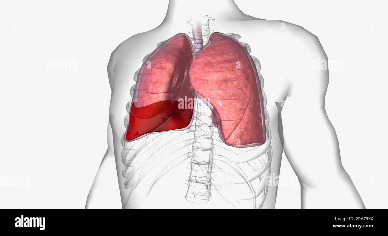 El hemotórax es una afección pulmonar en la que la sangre se acumula
