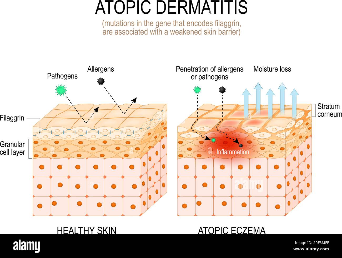 Dermatitis atópica. Teoría de la filaggrina y eczema atópico. las mutaciones en el gen que codifica la filaggrina están asociadas con una barrera cutánea debilitada. Ilustración del Vector