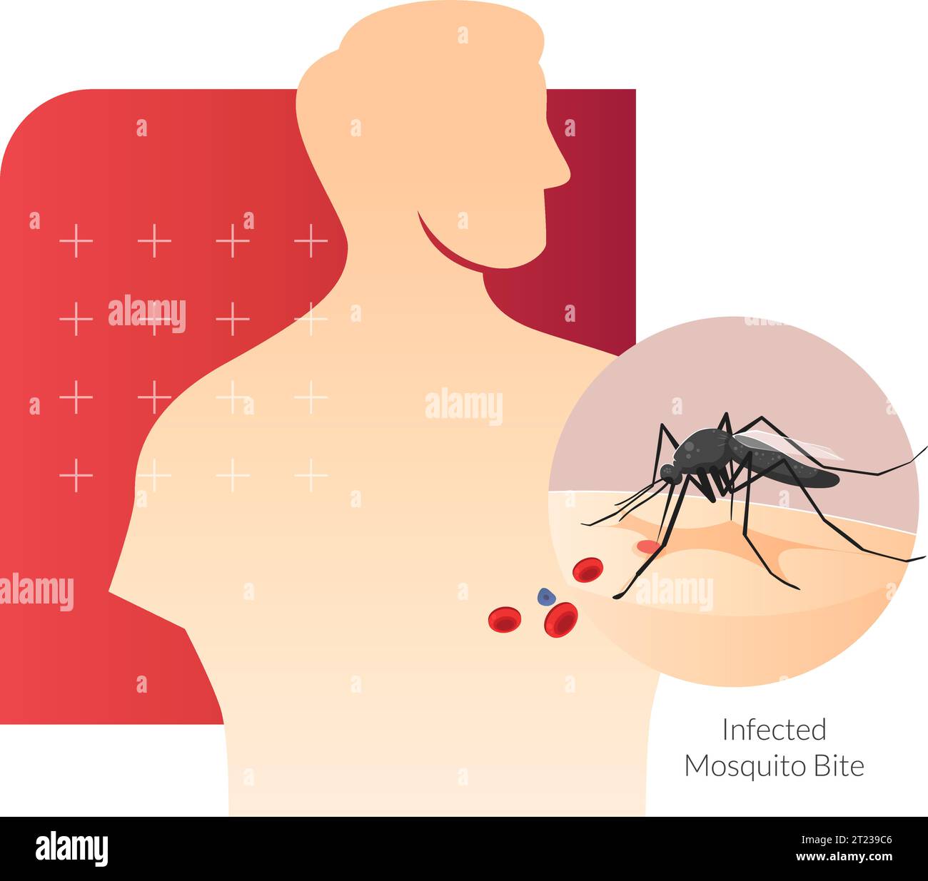 Mosquito mordiendo en la piel humana - Ilustración de stock como EPS 10 archivo Ilustración del Vector