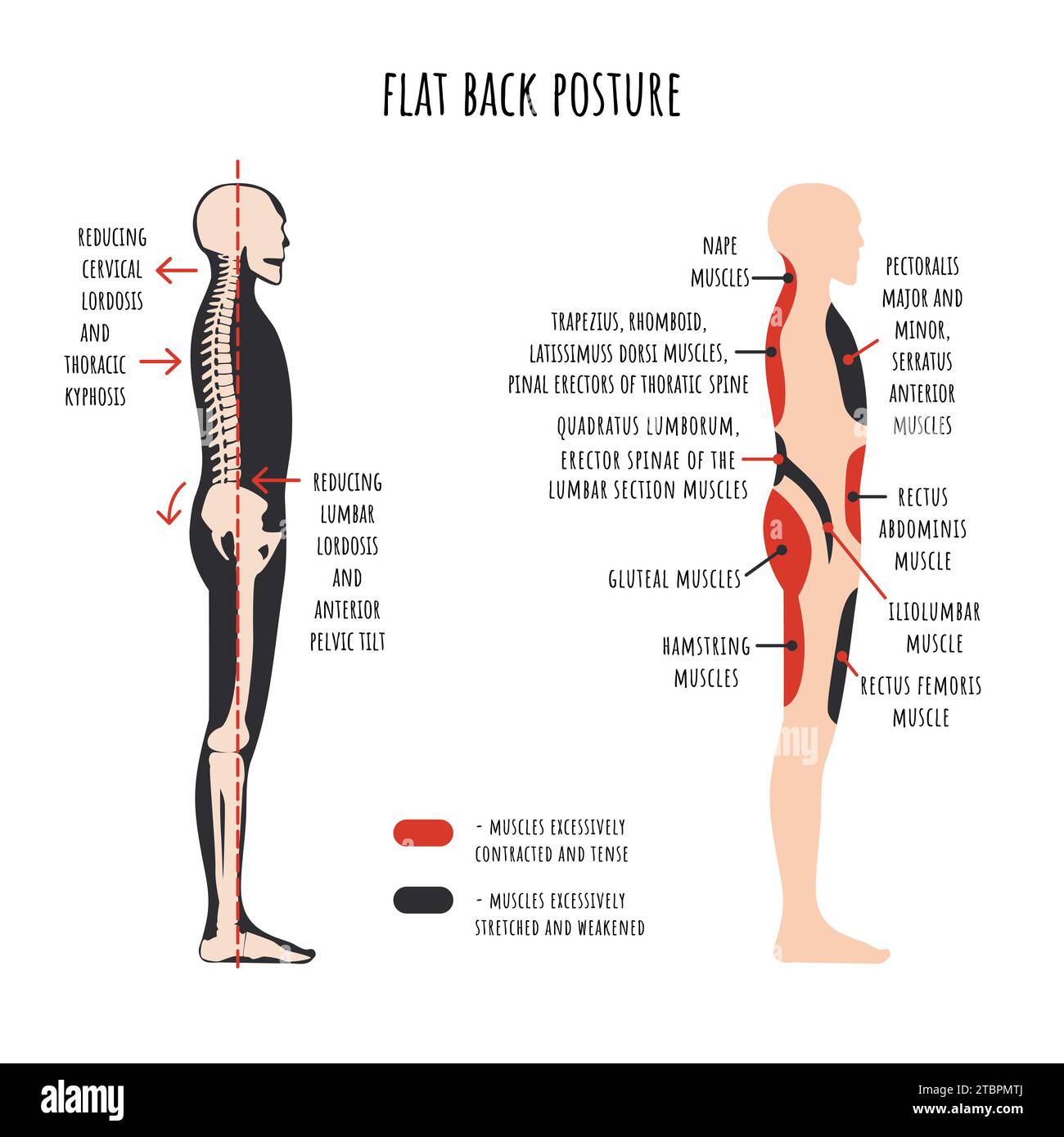 Infografía de trastornos de postura. Postura de espalda plana. La vista