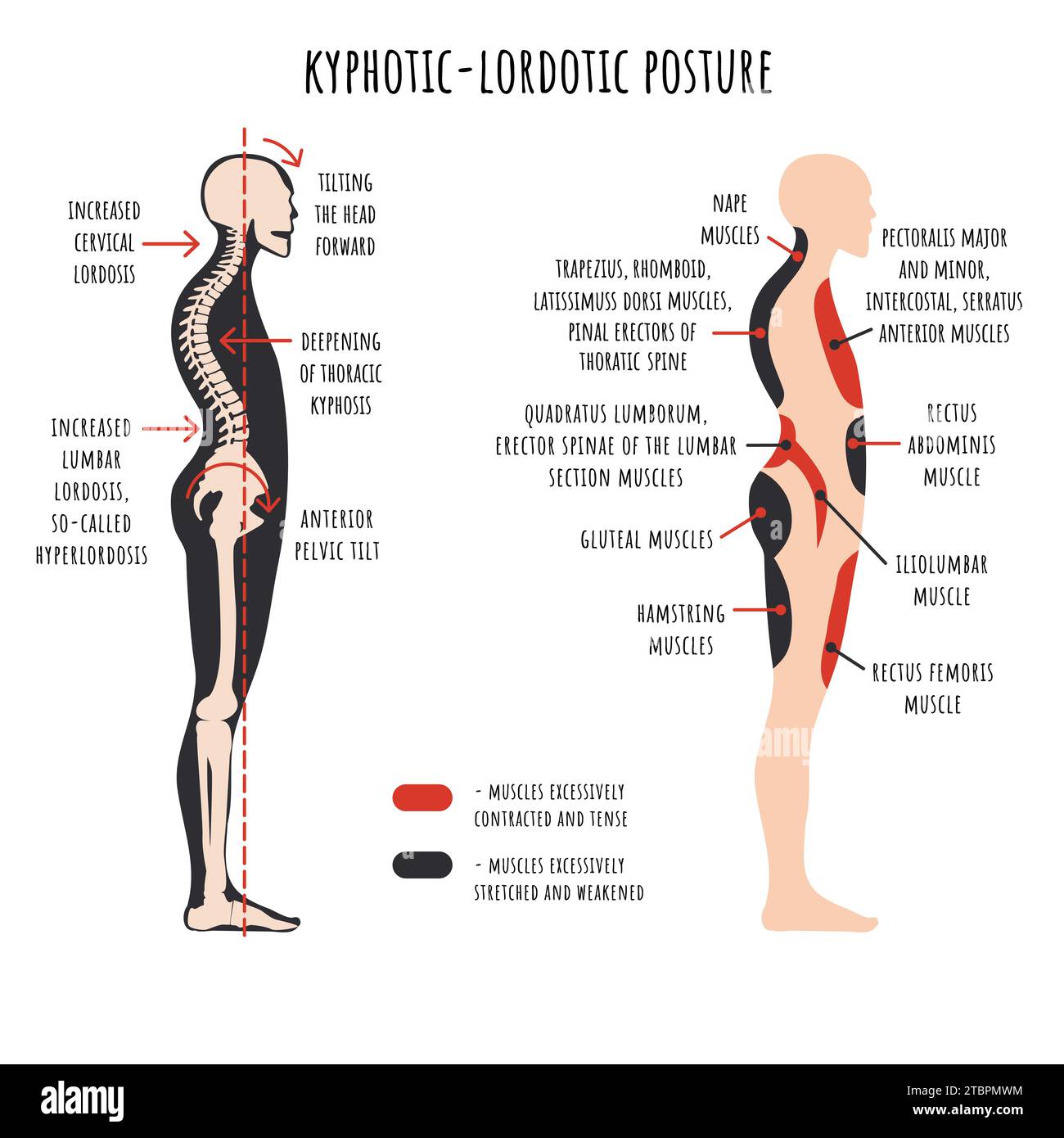 Infografía de trastornos de postura. Postura lordótica cifótica. La