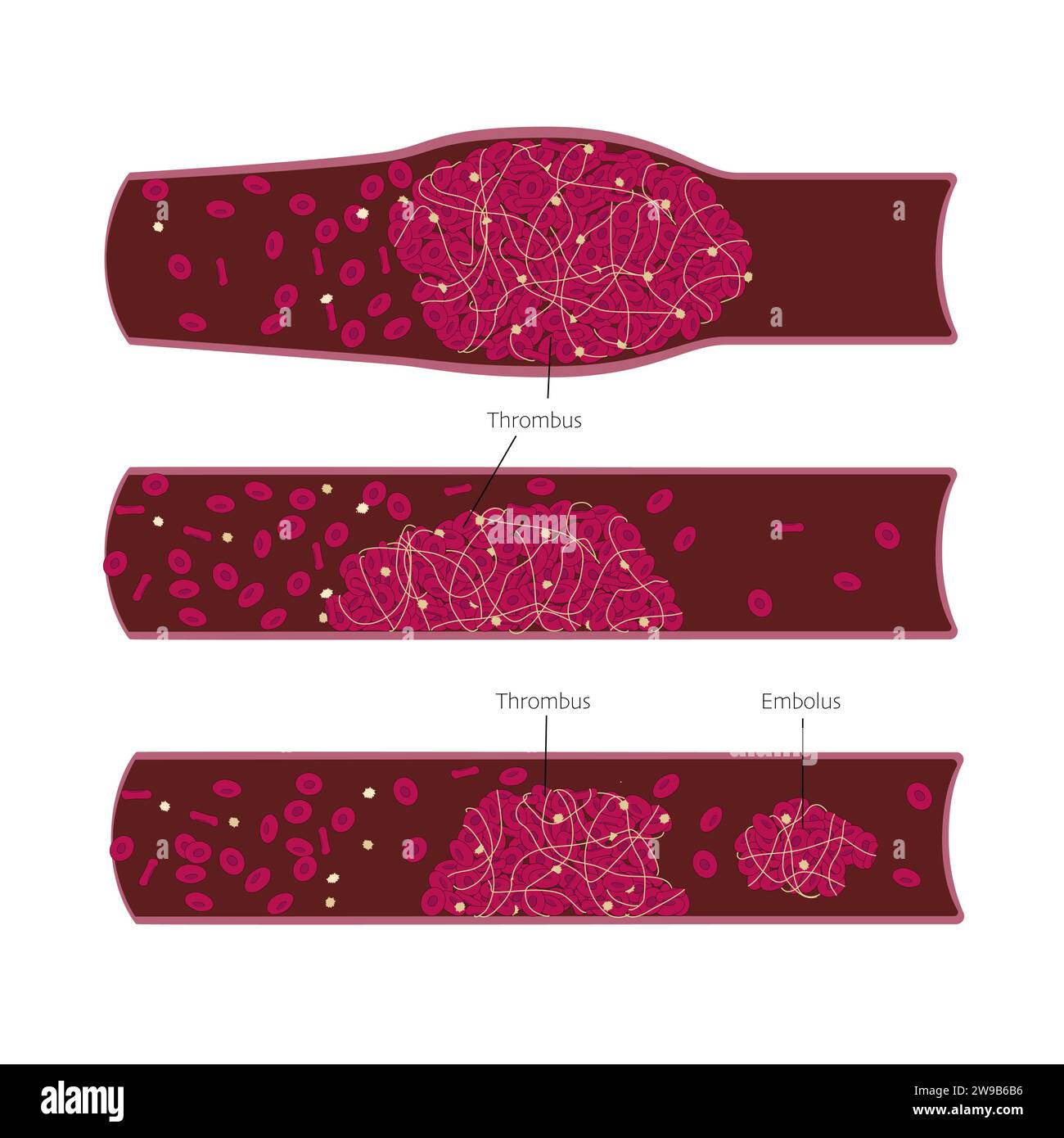 Diferentes tipos de trombo y émbolo en los vasos sanguíneos ilustración ...