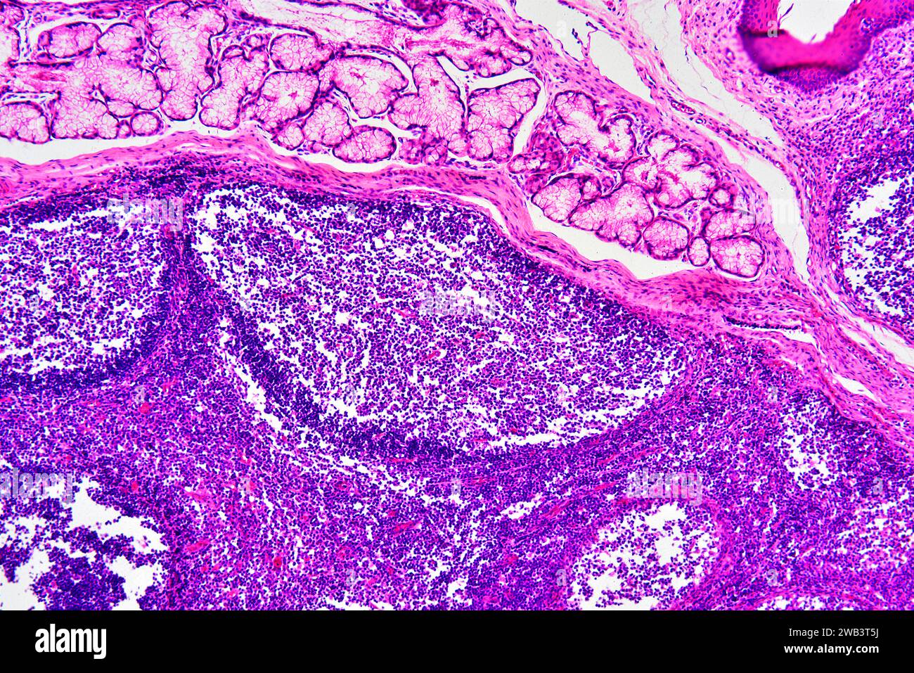 Sección de amígdalas palatinas humanas que muestra folículos linfoides circulares y glándula secretora. Micrografía de luz, tinción de eosina hematoxilina. X75 cuando se imprime 10 Foto de stock