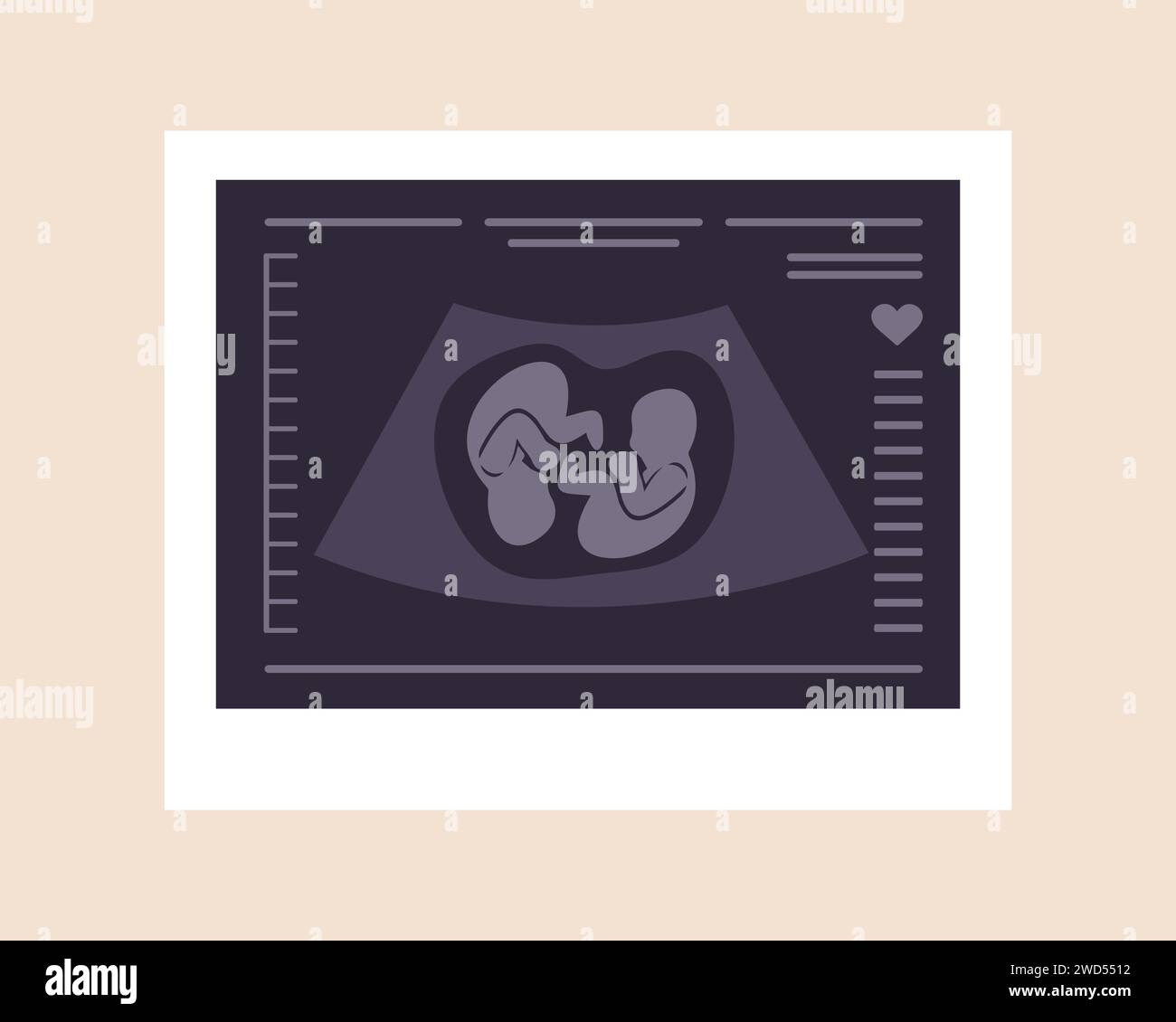 Twins embryo baby fotografías e imágenes de alta resolución - Alamy