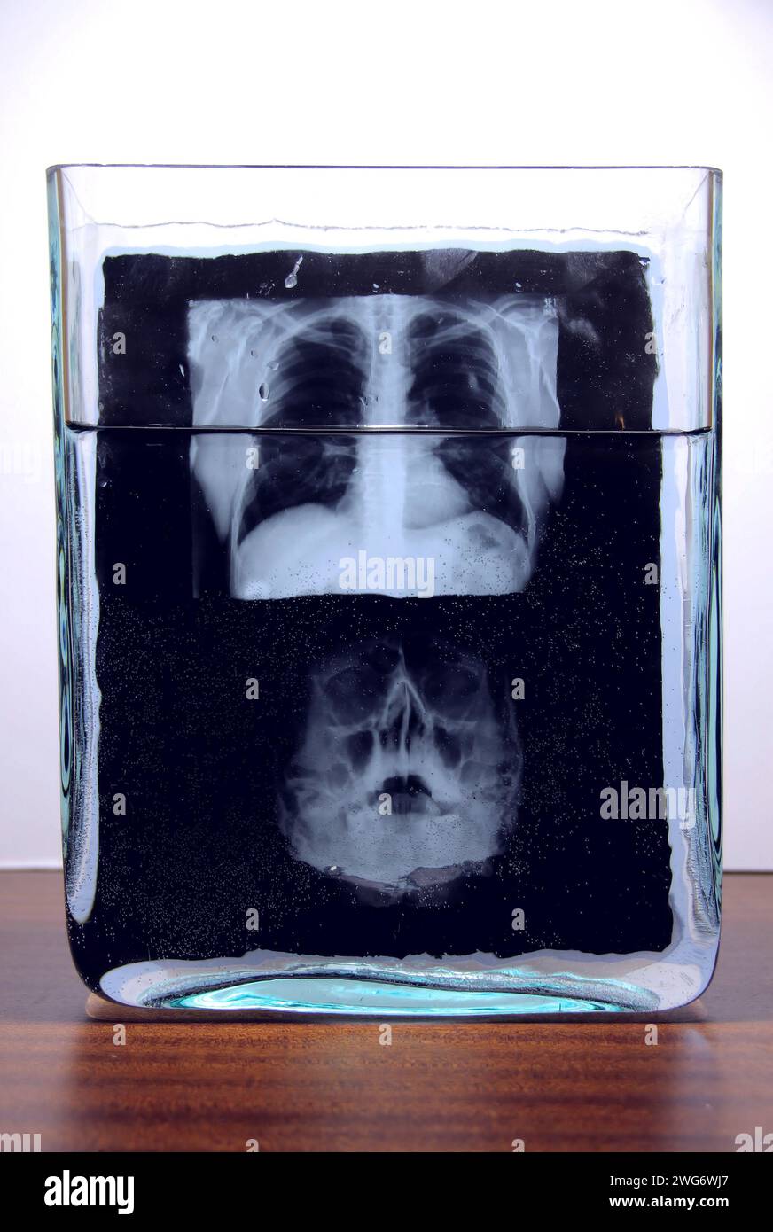Película de resultados de radiografía de la exploración de rayos X del cráneo humano en vaso de laboratorio de vidrio con líquido Foto de stock