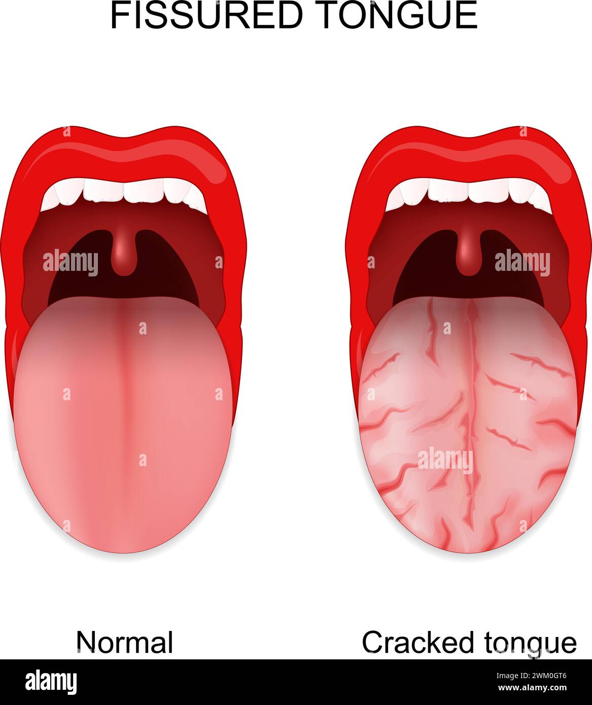Lengua fisurada. Lengua sana y agrietada. Anomalías de la cavidad oral. Ilustración vectorial Ilustración del Vector