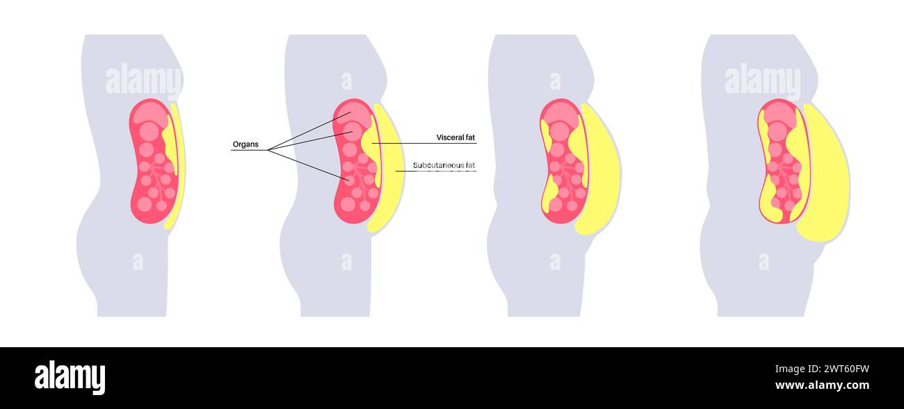 Diagrama de grasa visceral, ilustración. La grasa del vientre rodea los órganos internos en la cavidad abdominal. Foto de stock