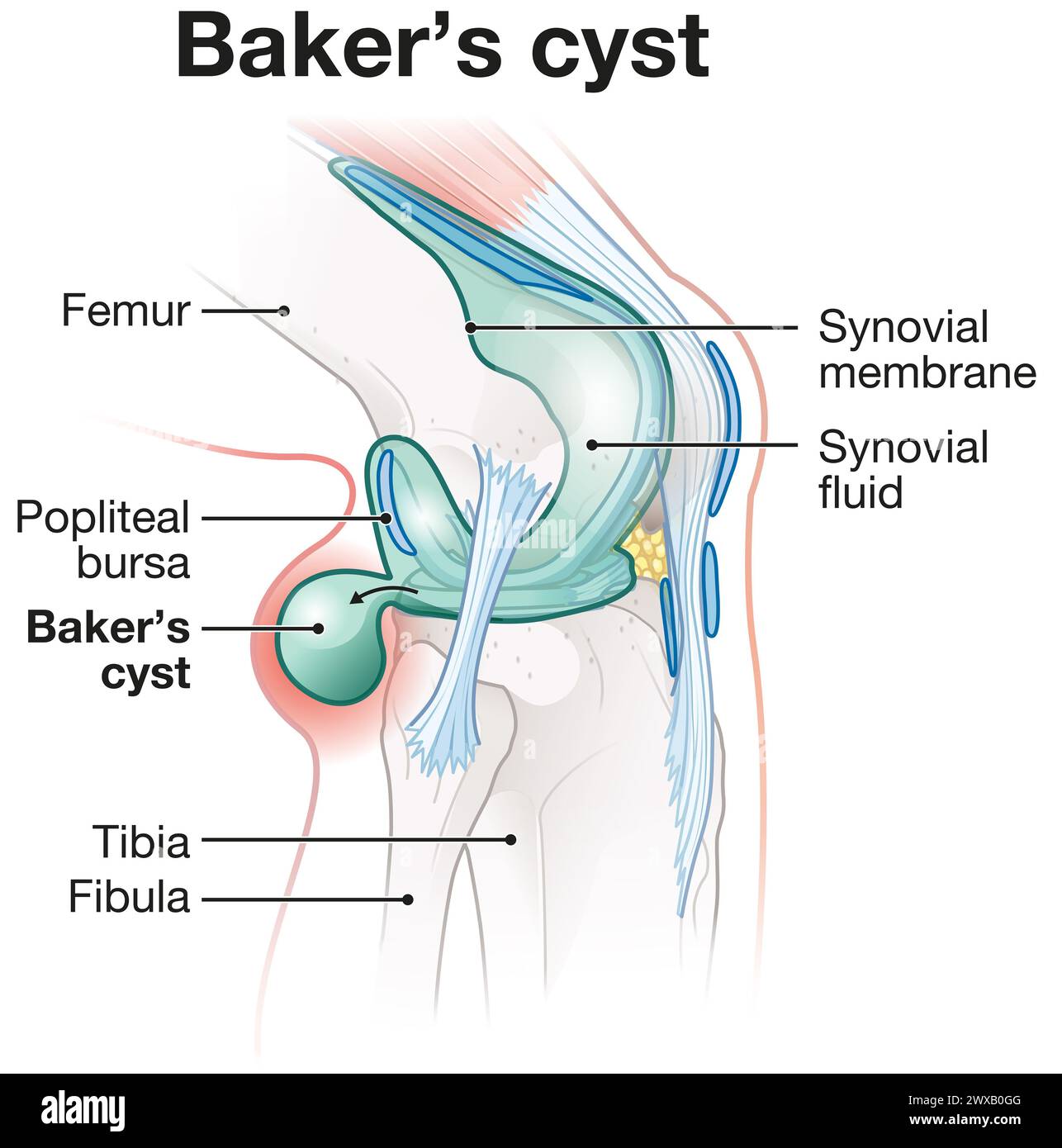 Quiste de Baker: Hinchazón llena de líquido detrás de la rodilla debido a problemas subyacentes de la rodilla, que causan dolor, rigidez, puede requerir tratamiento. Foto de stock