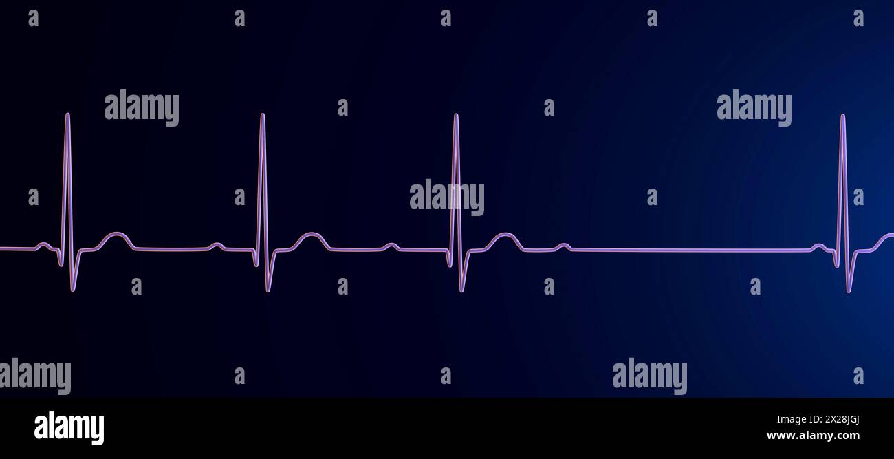 ecg anormal etiquetado