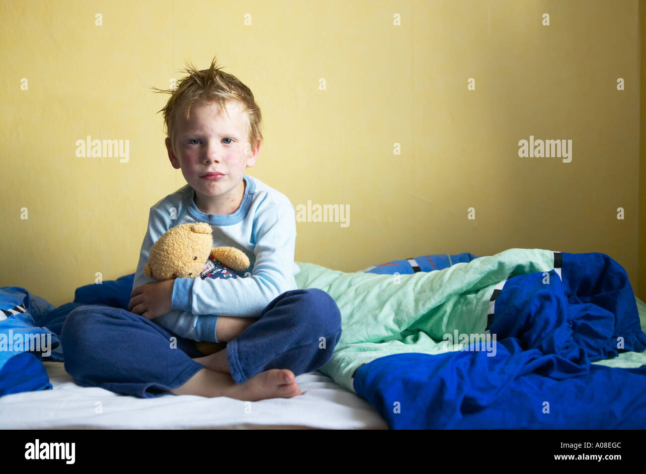 Joven enfermo con varicela en su cama DEU ALEMANIA Fotografía de stock -  Alamy