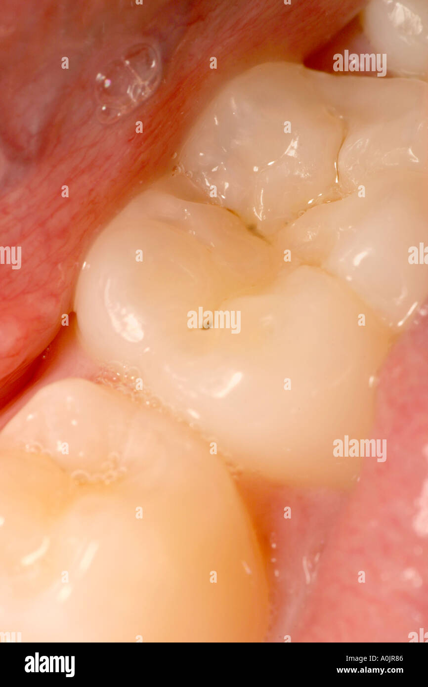 Agujero del diente fotografías e imágenes de alta resolución - Alamy