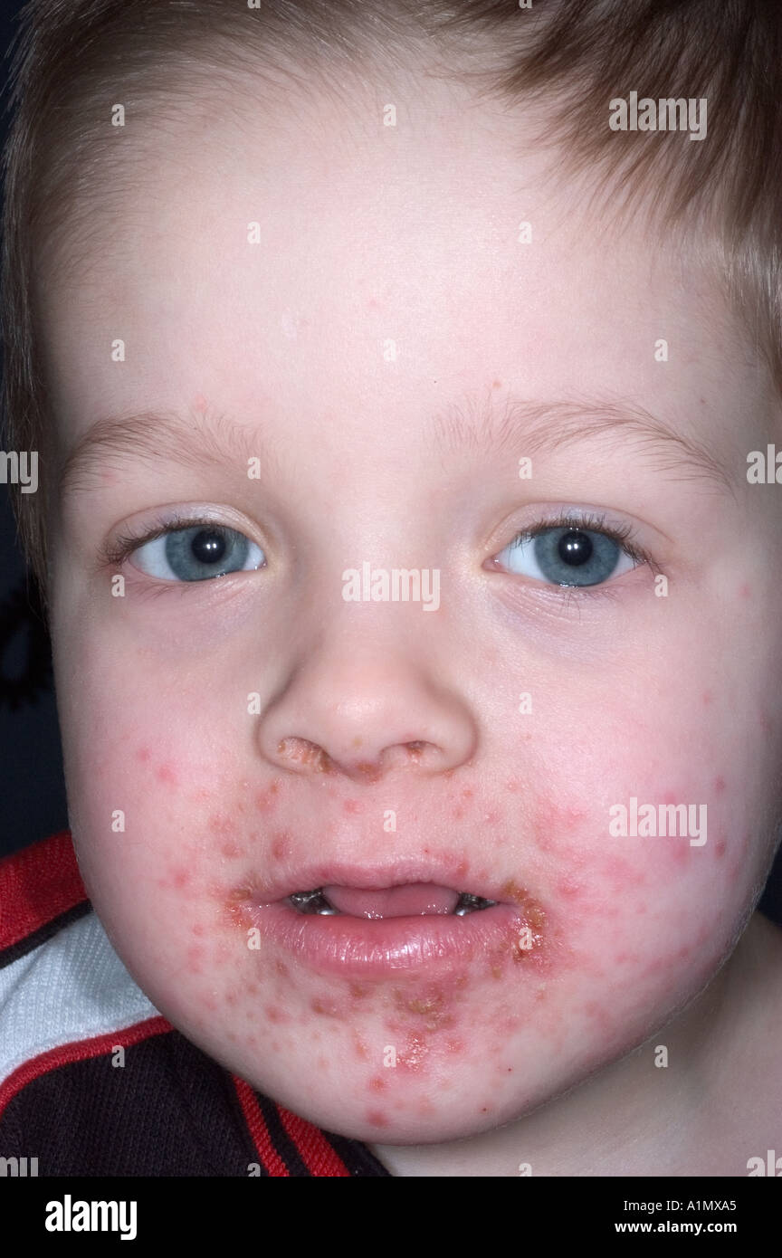 Nino Con Impetigo Erupcion Fotografia De Stock Alamy