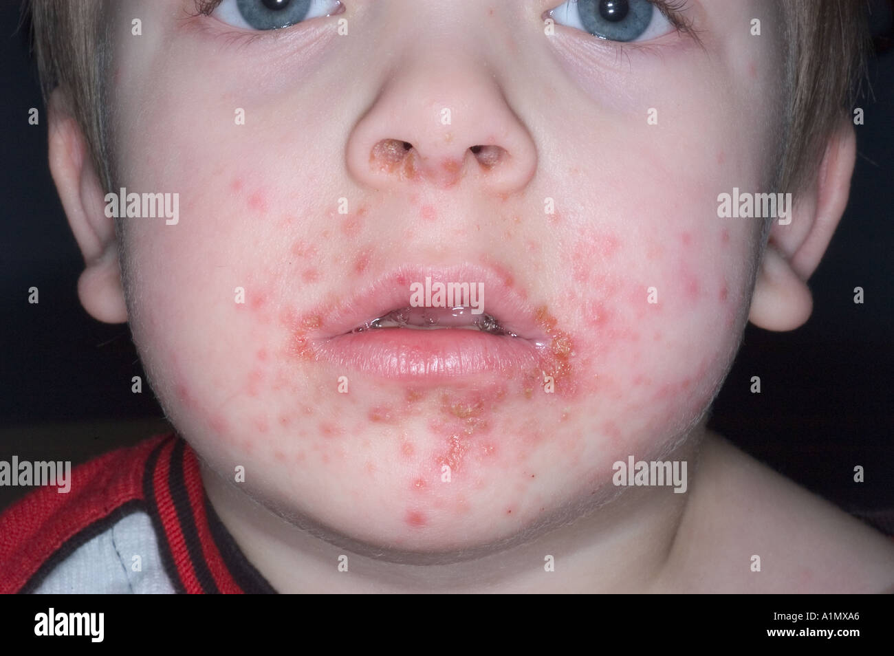 Child Impetigo Rash Fotos E Imagenes De Stock Alamy