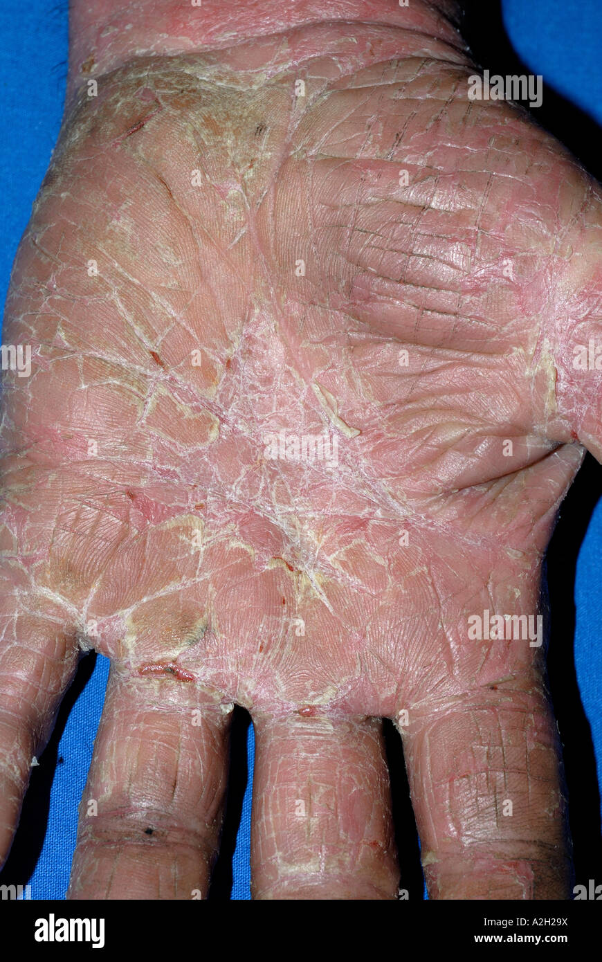 Erupción cutánea de eccema en las palmas de las manos de un hombre de 55  años de edad mostrando graves la exfoliación de la piel Fotografía de stock  - Alamy