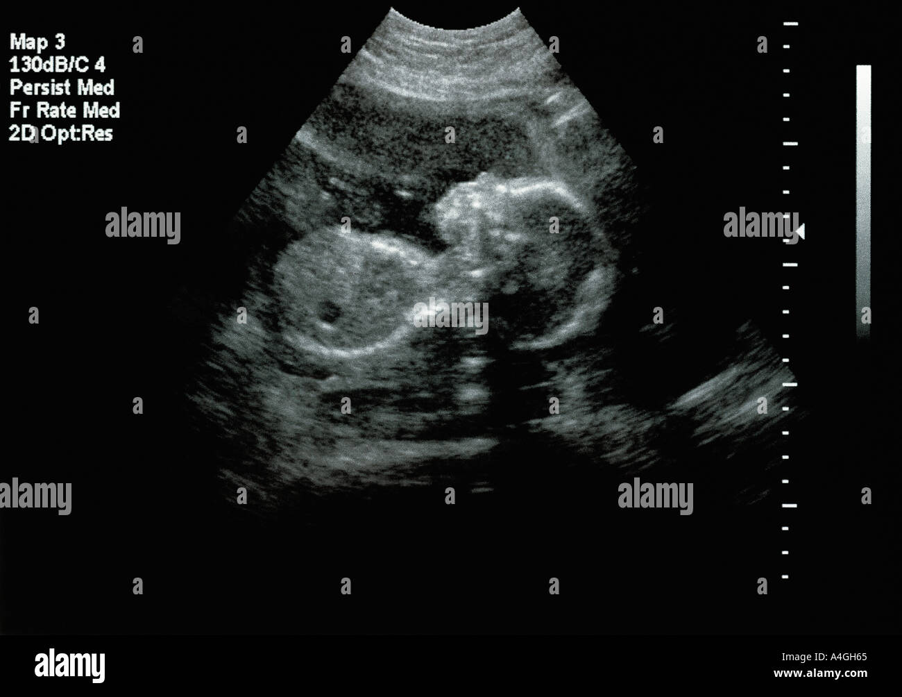 Ultra sound baby fotografías e imágenes de alta resolución - Alamy