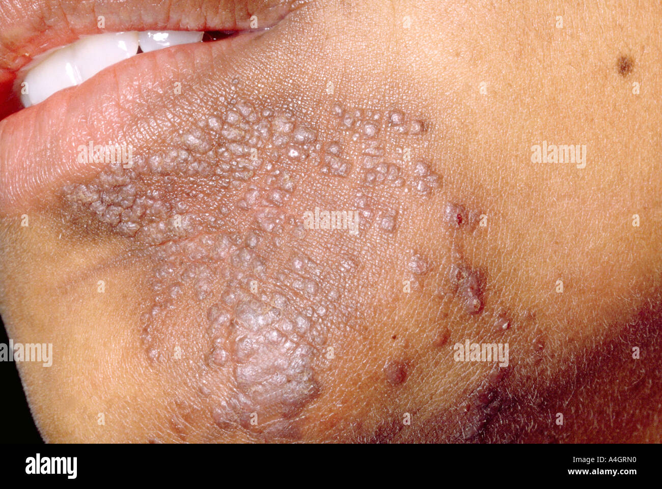 Verruga plana es un pequeño, de color carne, plana rematada lesión que ocurre comúnmente en la cara, cuello, dorso de las manos Foto de stock