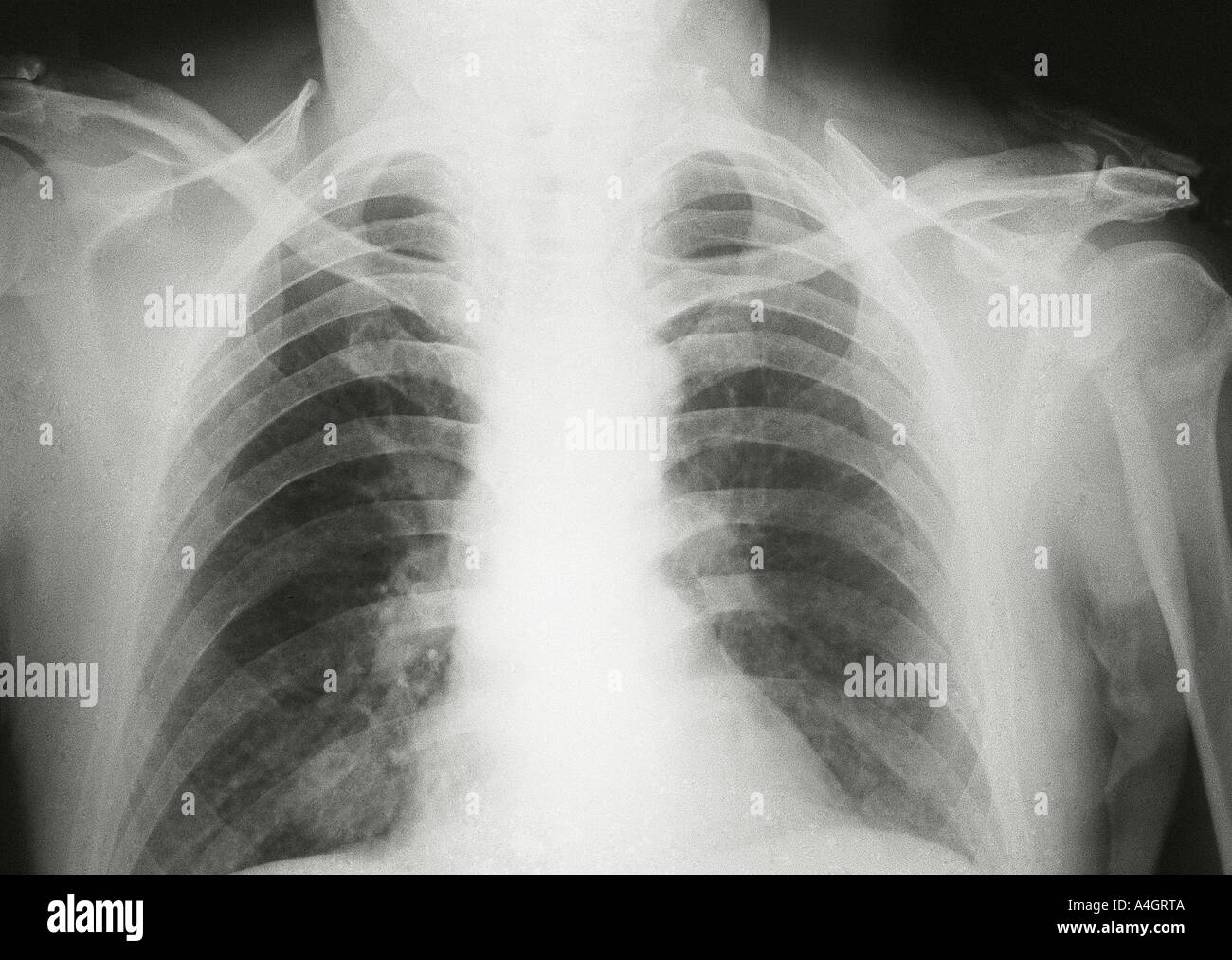 Una radiografía de tórax de un paciente con cáncer de pulmón, mostrando una  sombra en el pulmón Fotografía de stock - Alamy