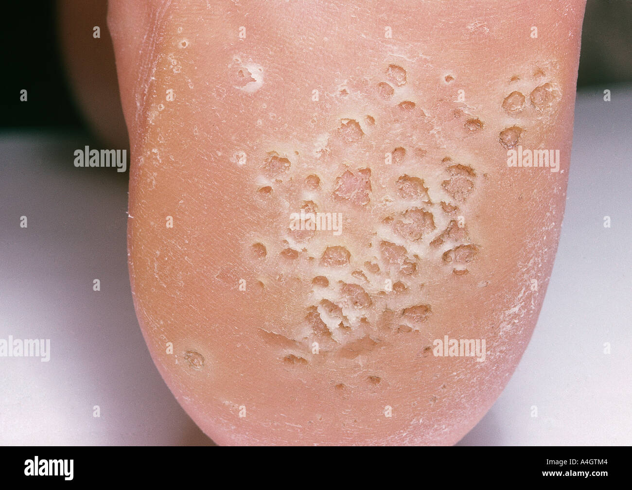Verrugas en mosaico fotografías e imágenes de alta resolución Alamy