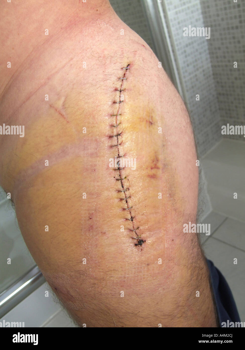 El reemplazo de cadera herida y cicatriz una semana después de la operación de reemplazo de cadera Birmingham Foto de stock