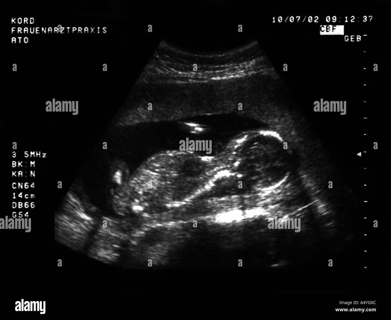 Ultrasound image a fetus fotografías e imágenes de alta resolución - Alamy