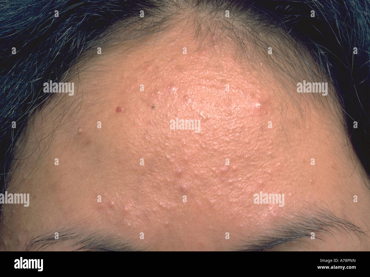 Acné inducido por esteroides Fotografía de stock Alamy