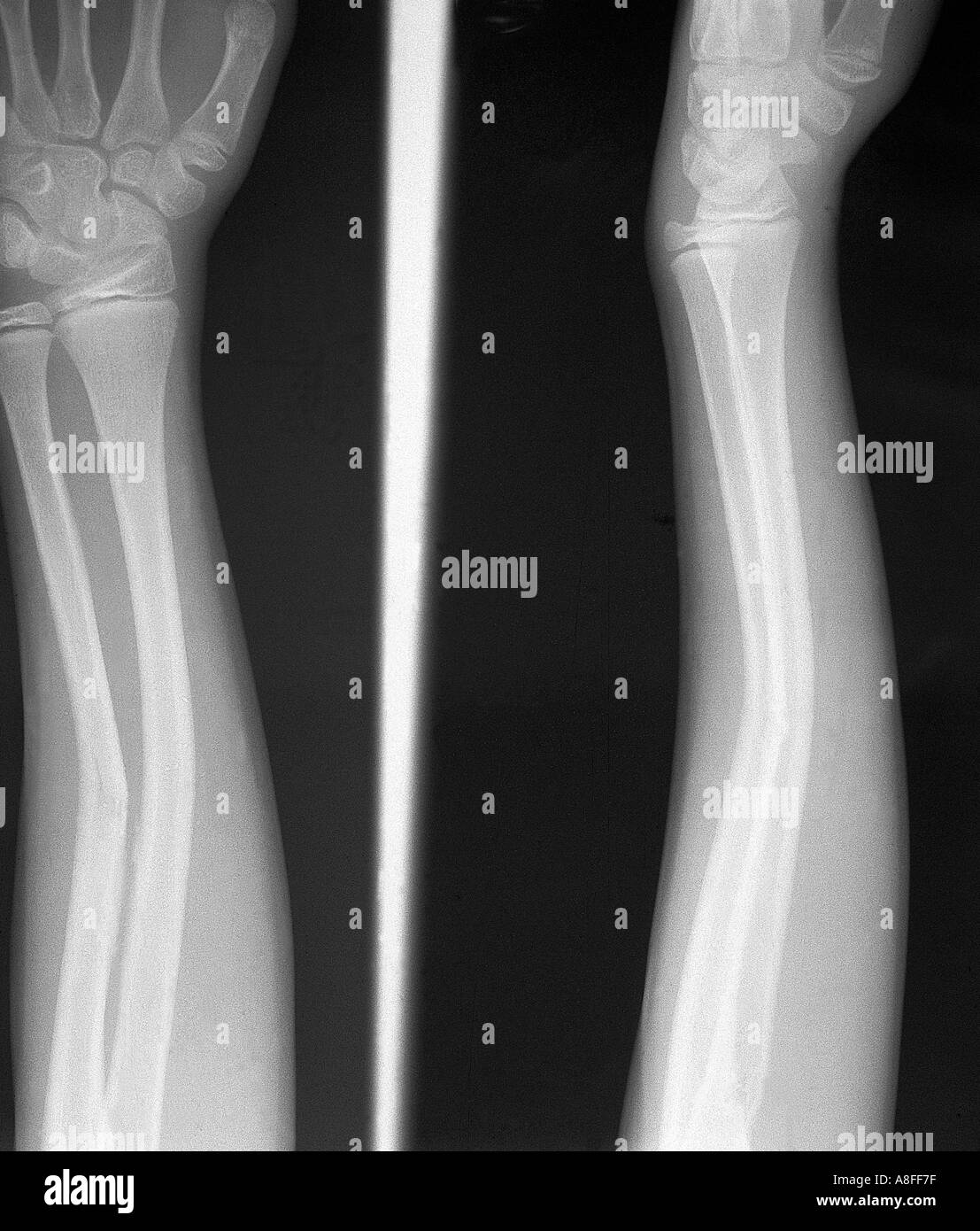 X ray greenstick fractura de radio y cúbito arqueamiento de Fotografía de  stock - Alamy