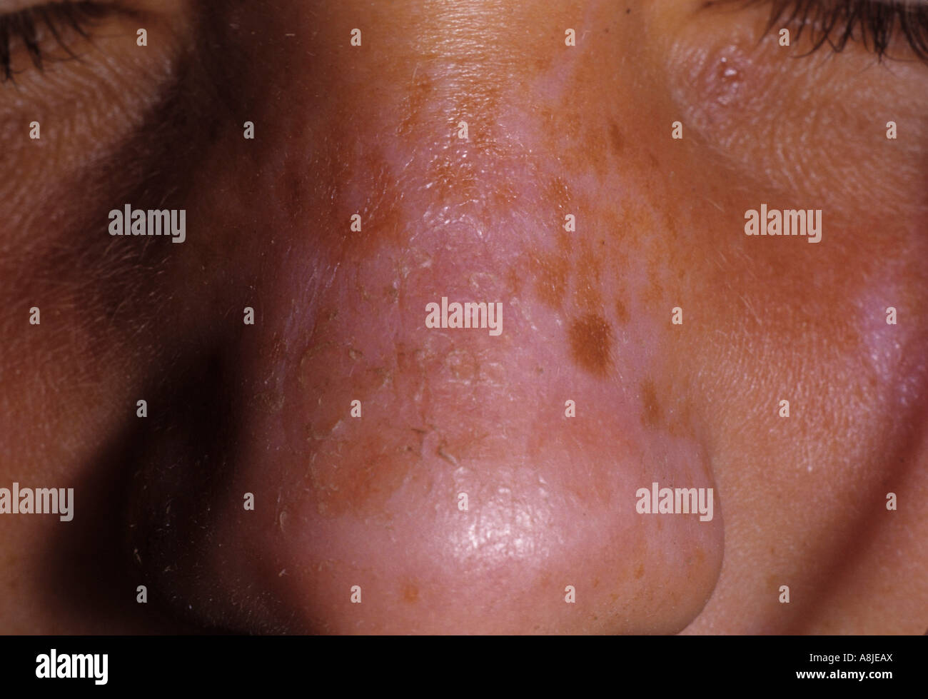 Las quemaduras de sol en la nariz. Los rayos ultravioleta causa