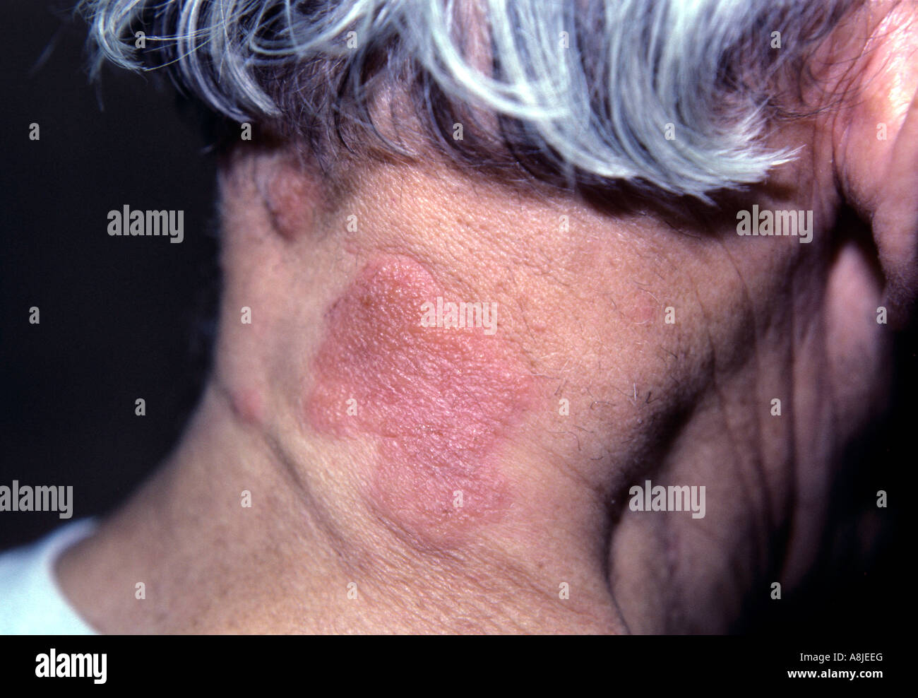 Alergia a la ropa. La erupción aparece en el cuello del paciente Fotografía  de stock - Alamy