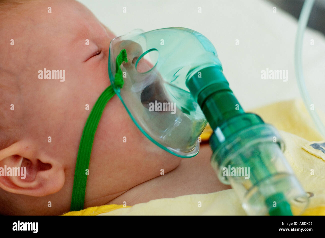 Новорожденный тяжело дышит. Аппарат ИВЛ для недоношенных. Оксигено терапия новорожд.