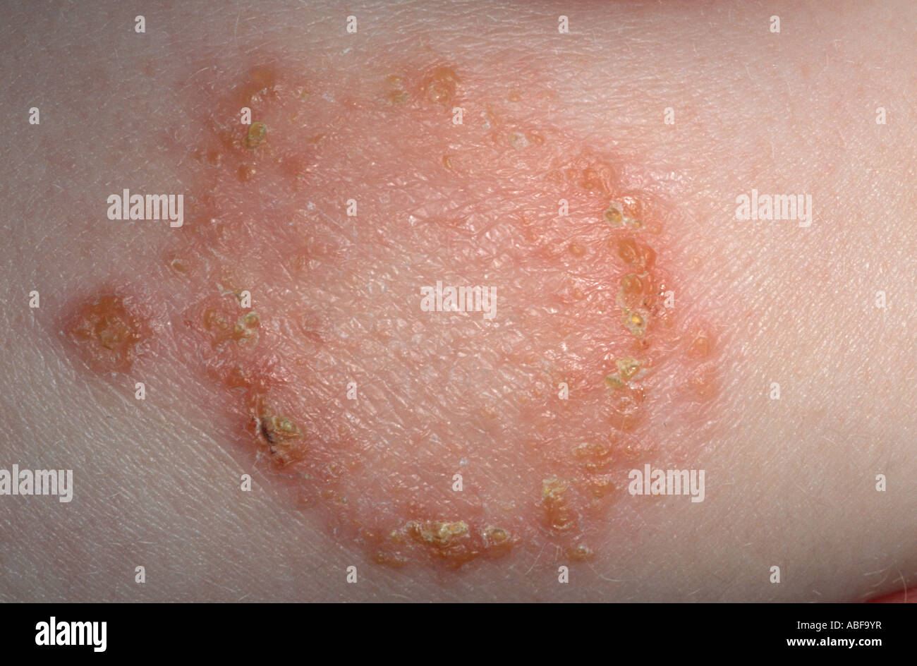 Impétigo, una infección superficial por Staphylococcus aureus. Las vesículas se rompen formando costras de color miel. Foto de stock