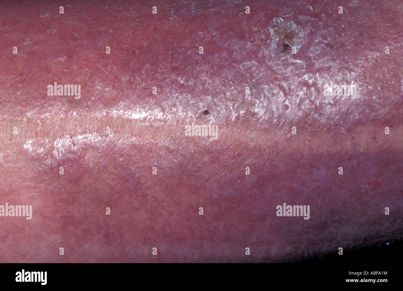 Eccema varicosa de la pierna asociado con insuffiency venoso Foto de stock