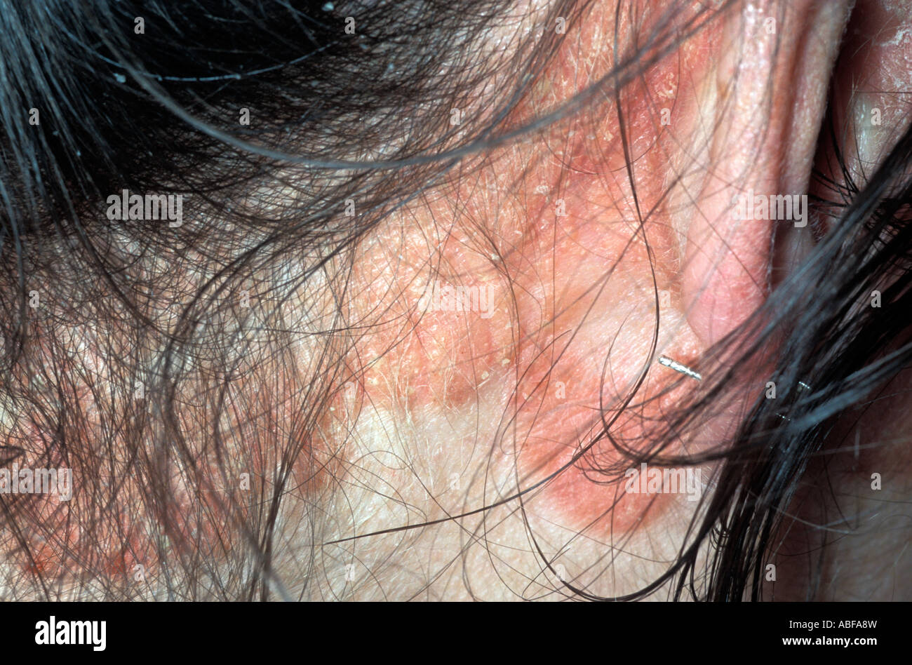 La dermatitis seborreica afecta el cuello y detrás de la oreja Fotografía  de stock - Alamy