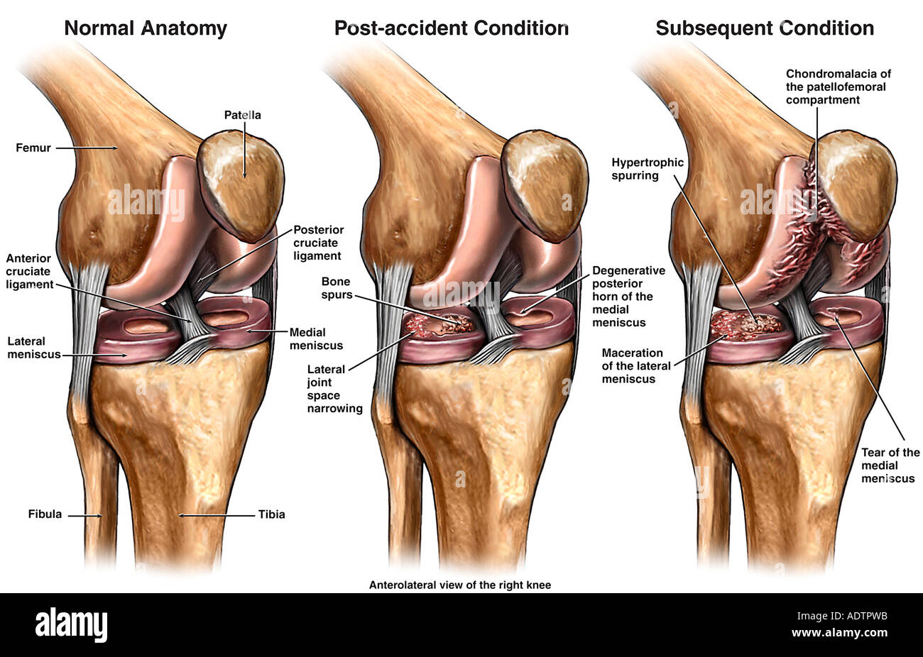 La condromalacia - Progresión de la lesión en la rodilla derecha Foto de stock