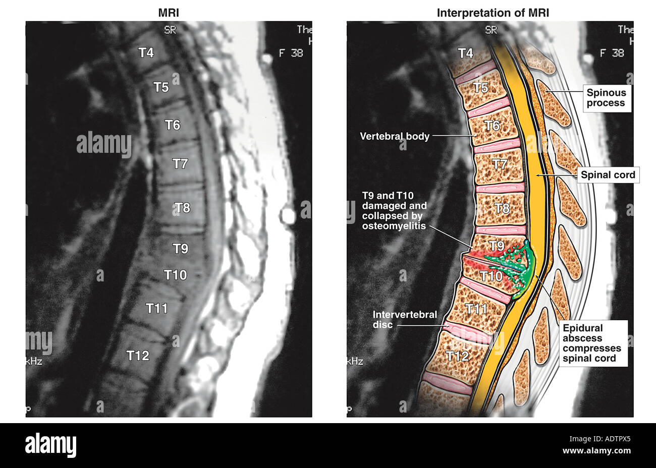 La compresión de la médula espinal - T9-10 absceso epidural. Foto de stock