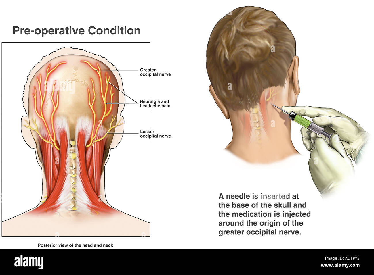 Inyección de bloqueo nervioso occipital Foto de stock