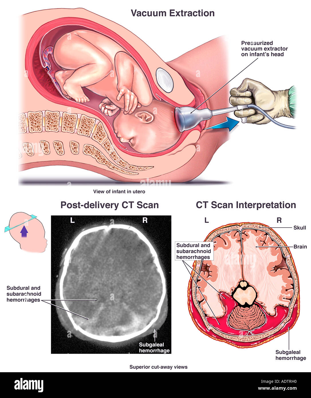 Вакуум экстрактор акушерский. Вакуум для родовспоможения. Что такое вакуумные роды. Вакуумный экстрактор плода что это. Условия для проведения вакуум-экстракции плода.