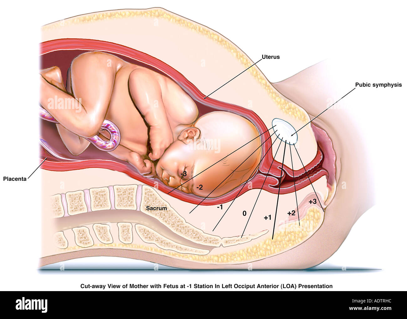 El trabajo de parto y el parto - Feto en loa posición en +2 Estación de presentación Foto de stock