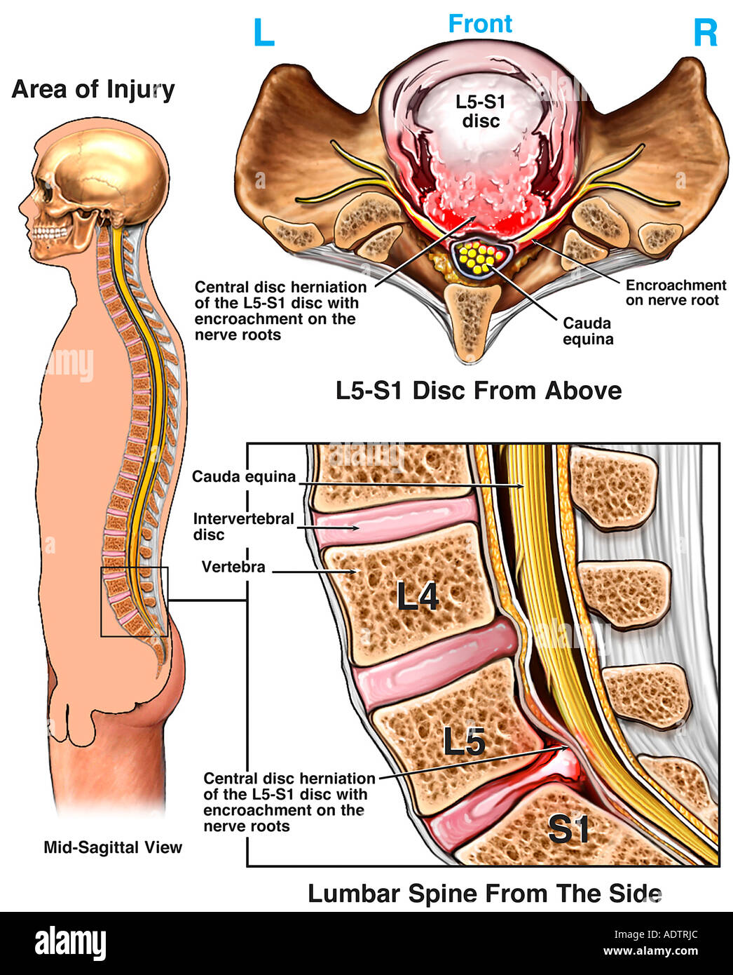 Enorme L5S1 de hernia discal lumbar con pinzamiento de la raíz del