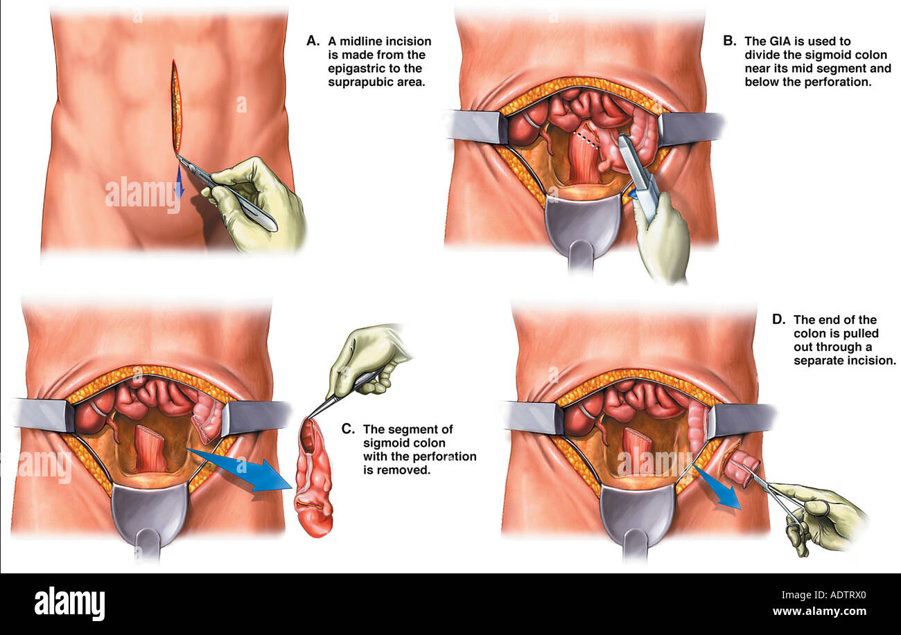 Cirugía del intestino grueso - resección con Colostomía Foto de stock