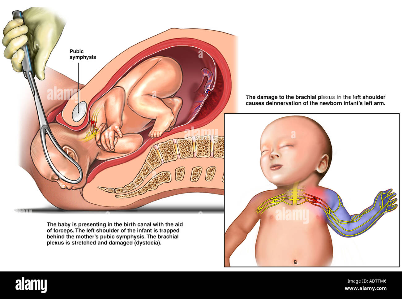 Dystocia Fotografias E Imagenes De Alta Resolucion Alamy Dystocia Fotografias E Imagenes De Alta Resolucion Alamy