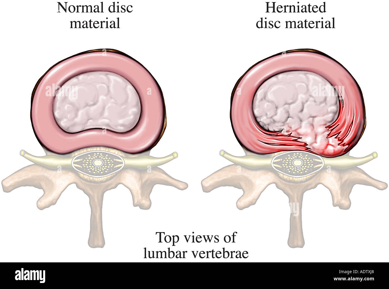 Hernia discal fotografías e imágenes de alta resolución Alamy